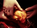 Transplantace srdce
