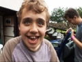 Syndrom Smith Magenis